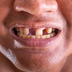 A closeup of a man with missing teeth