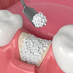 Illustration of bone grafting process