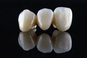 dental bridge