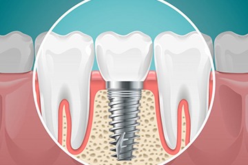 dental implant post in the jaw