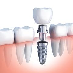 dental implant post with abutment and crown in the jaw