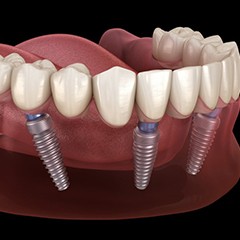 implant denture on the bottom jaw