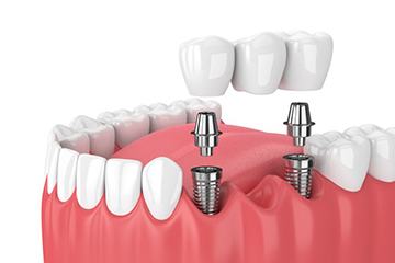 two implant posts supporting a dental bridge