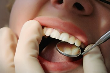 Closeup of patient with tooth-colored filling in Naples