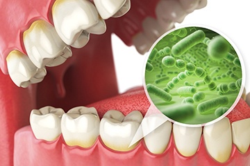 Rendering of teeth with germs along the gums with white background