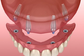 An example of implant dentures from Galleria Dentistry