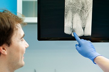 Digital dental x-rays