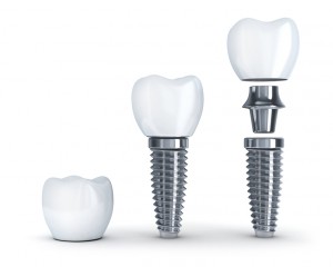 Your dentist explains dental implants in Naples FL