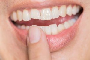 Closeup of patient with chipped tooth in Naples