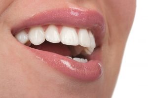 Small teeth treated with veneers