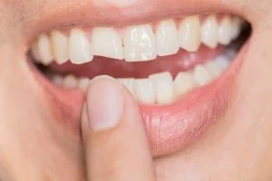Will a Chipped Tooth Heal on Its Own?