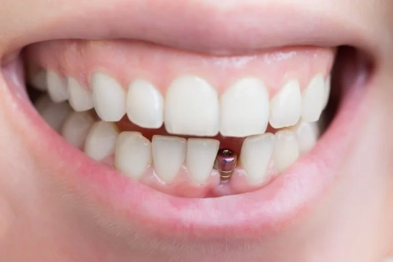 How Can Dental Implants Save Me Money?