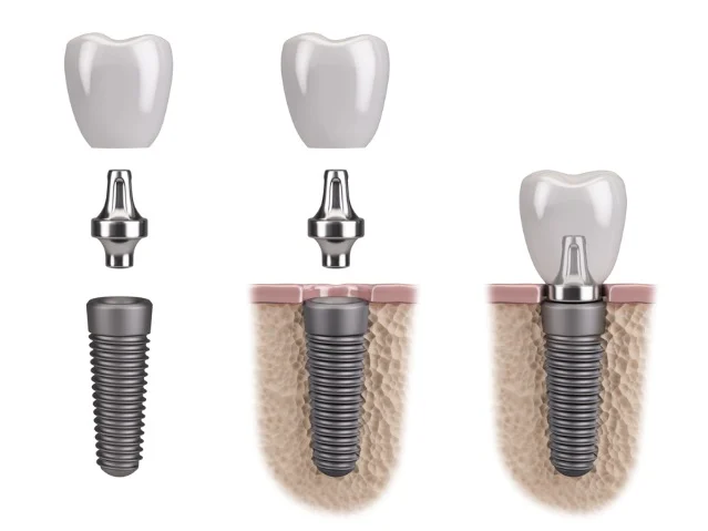 Will Dental Implants Set Off Metal Detectors? Ask a Dentist