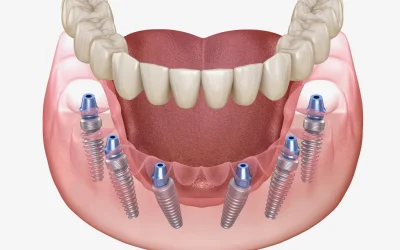 All-On-X dental implants in Naples, FL