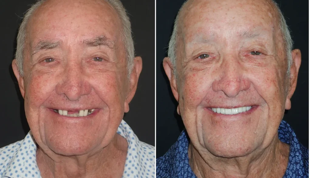 All-on-X dental implants case 2, before and after: smiling older man, a gap in his teeth replaced with a full smile