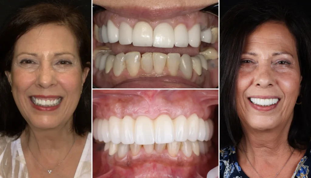 All-on-X dental implants case 3, before and after: smiling woman with dark hair, worn teeth replaced with a bright smile