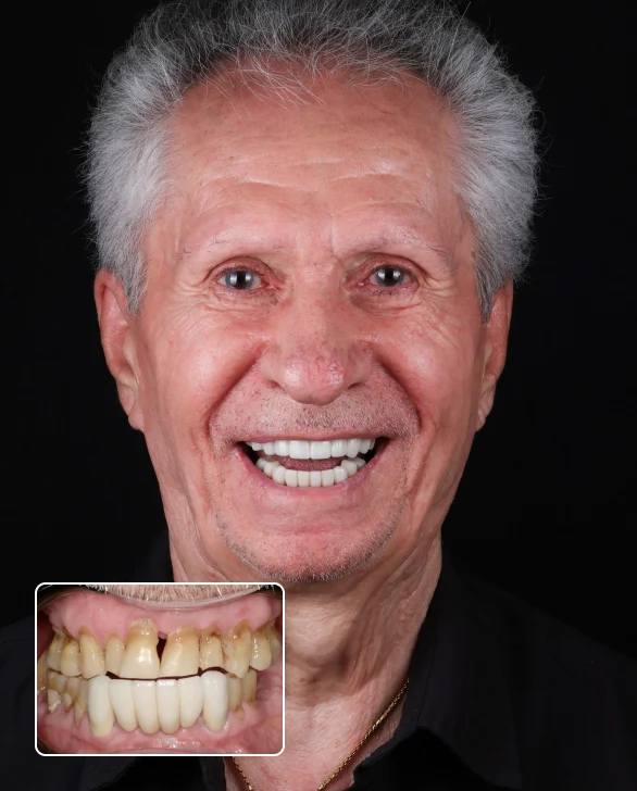 Smiling older man with gray hair and an inset photo of his smile before treatment