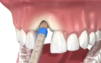 Bone Grafting in Naples, FL