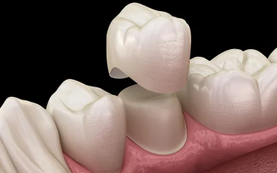 CEREC Same Day Crowns in Naples, FL