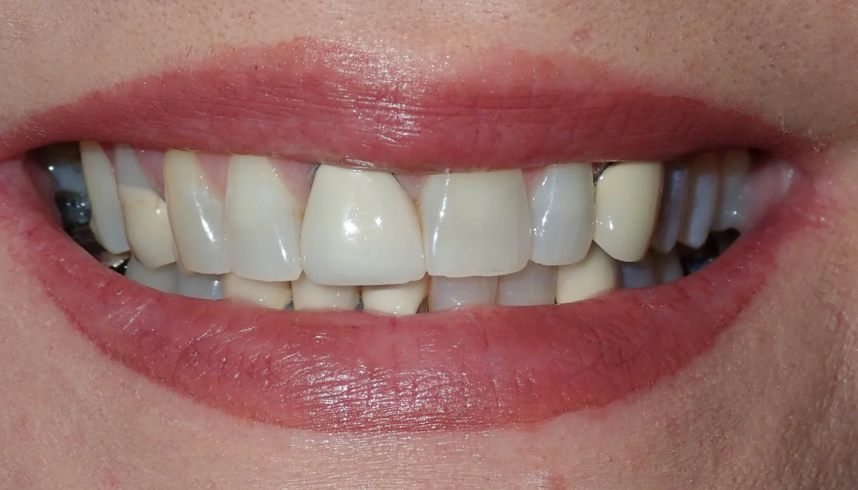 Crowns and bridges case 1, before treatment: uneven, discolored upper teeth in a wide smile