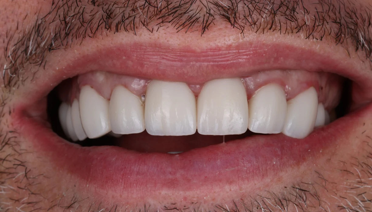 Crowns and bridges case 2, after treatment: bright, evenly shaped upper teeth