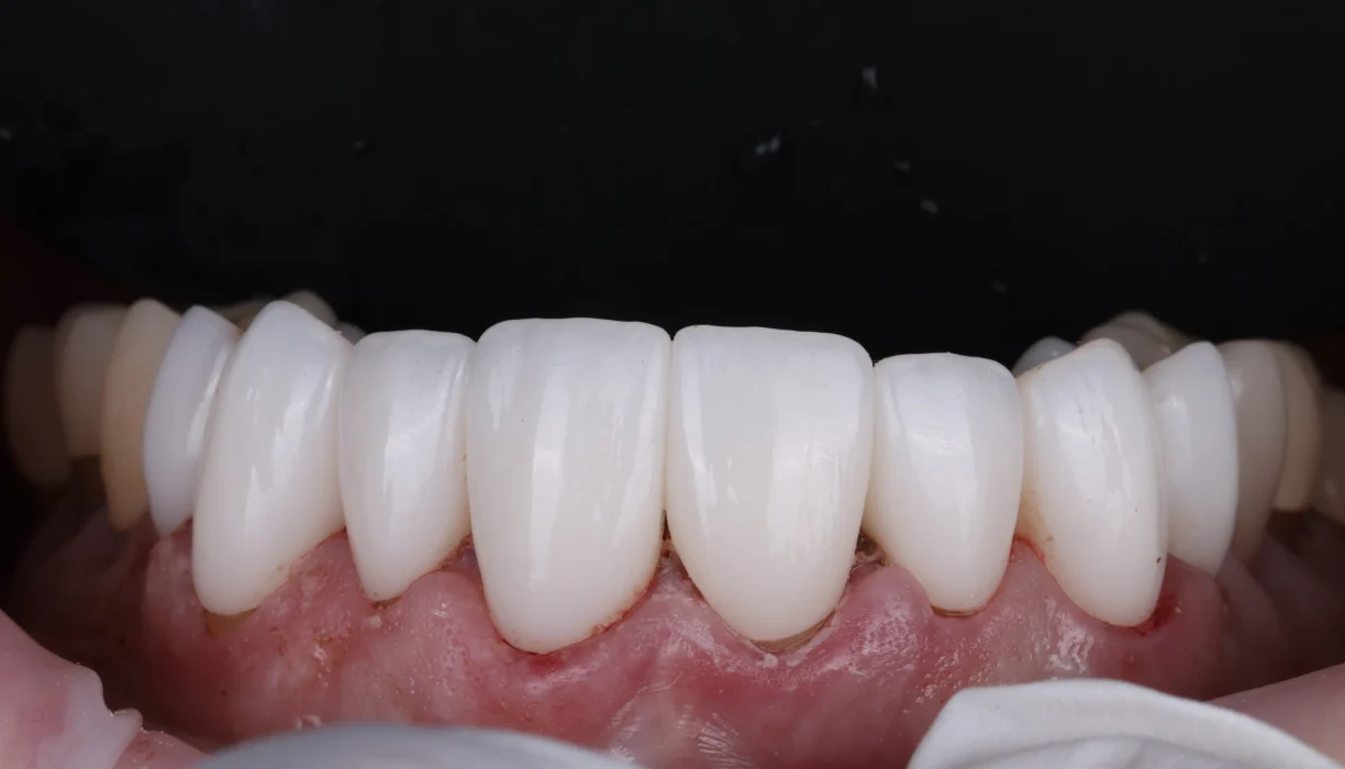 Crowns and bridges case 3, after treatment: white, evenly shaped lower front teeth