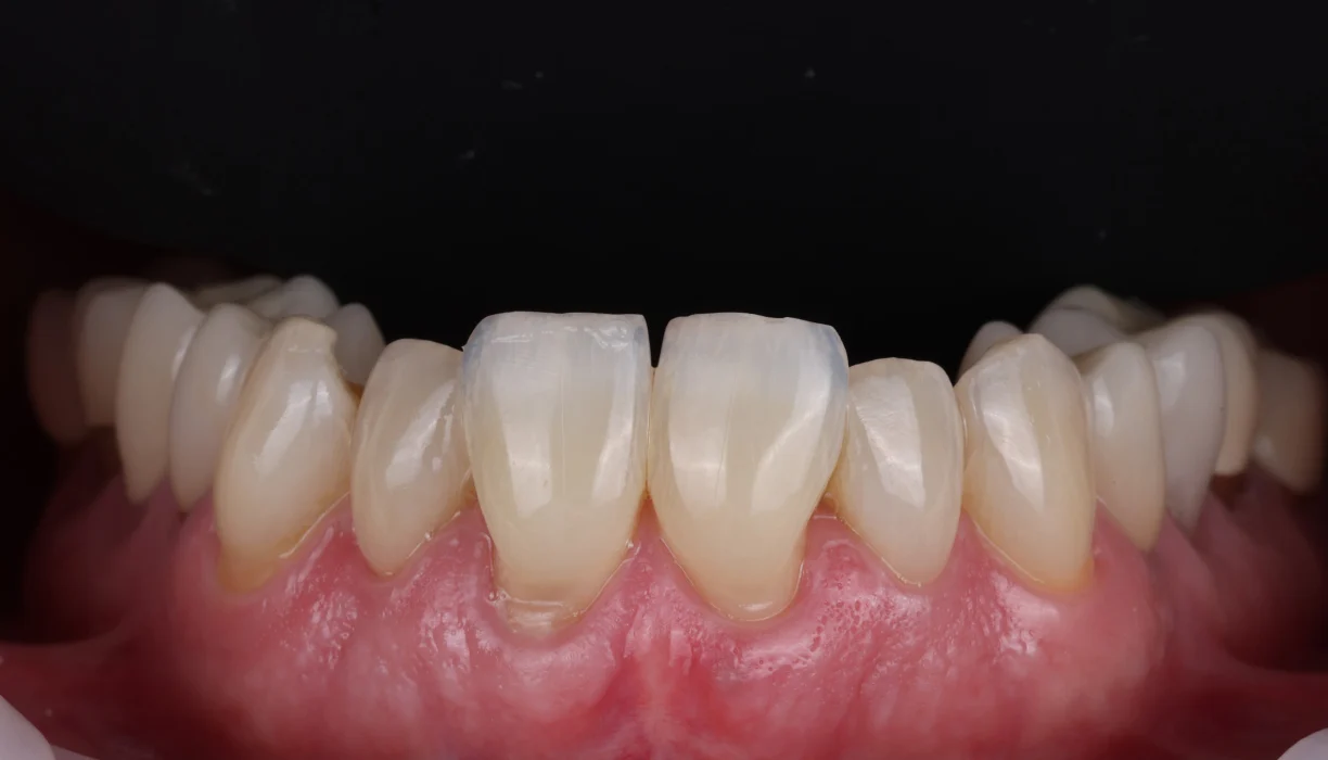 Crowns and bridges case 3, before treatment: yellowed lower front teeth