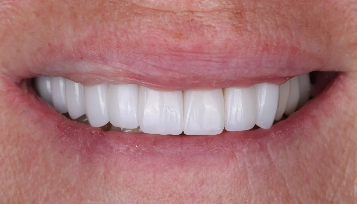 Crowns and bridges case 4, after treatment: bright white, evenly shaped upper teeth