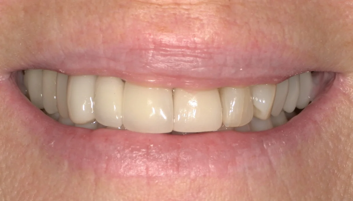 Crowns and bridges case 4, before treatment: yellowed upper teeth in a smile
