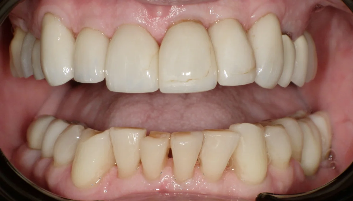 Crowns and bridges case 5, before treatment: worn, yellowed upper and lower teeth
