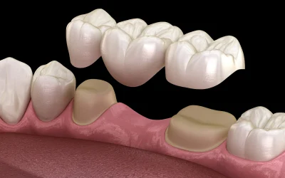 Dental Crowns & Bridges in Naples, FL