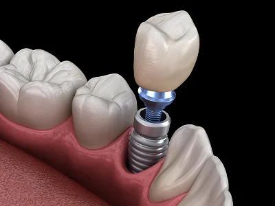 Illustration of a dental implant post and crown replacing a missing tooth