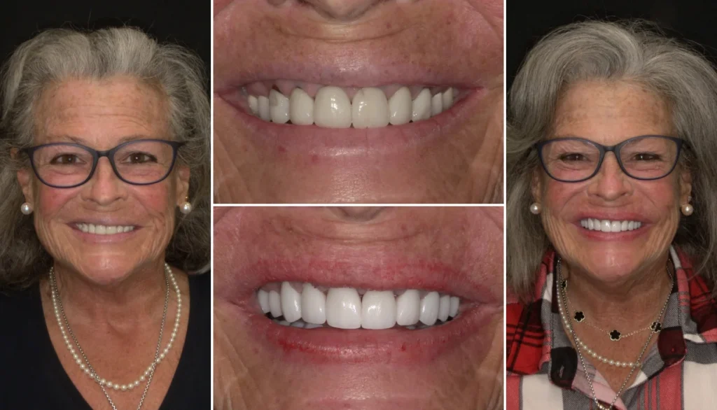 Full mouth reconstruction case 1, before and after: older woman with glasses, worn teeth restored to an even, brighter smile