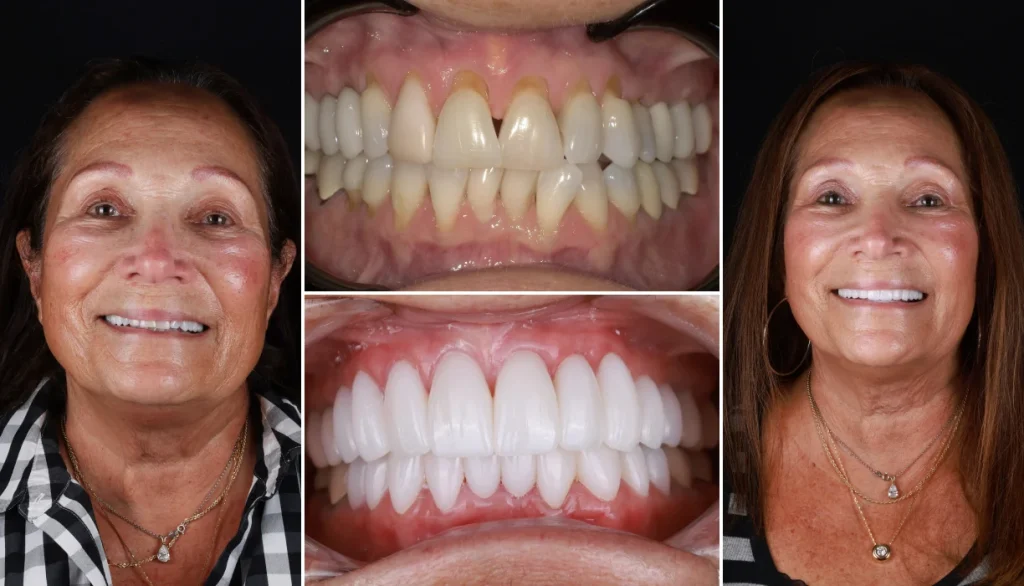 Full mouth reconstruction case 2, before and after: worn, short upper teeth replaced with a full, even set of teeth