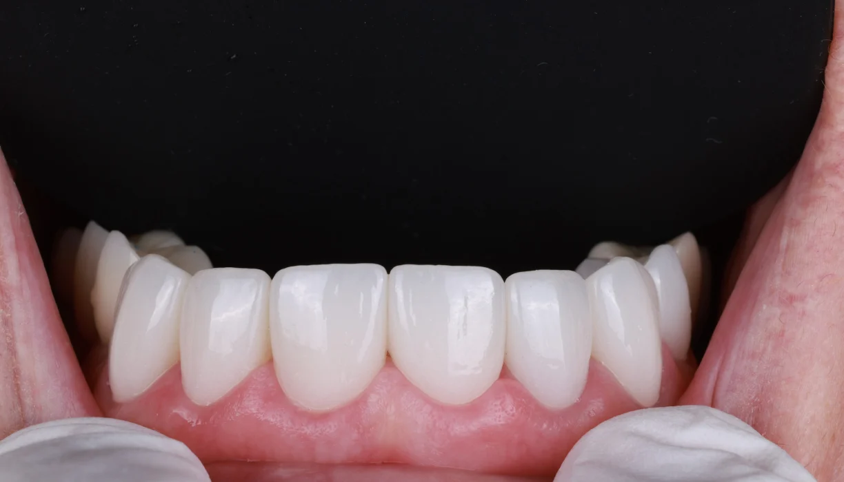 Full mouth reconstruction case 6, after treatment: evenly shaped lower teeth in a straight row