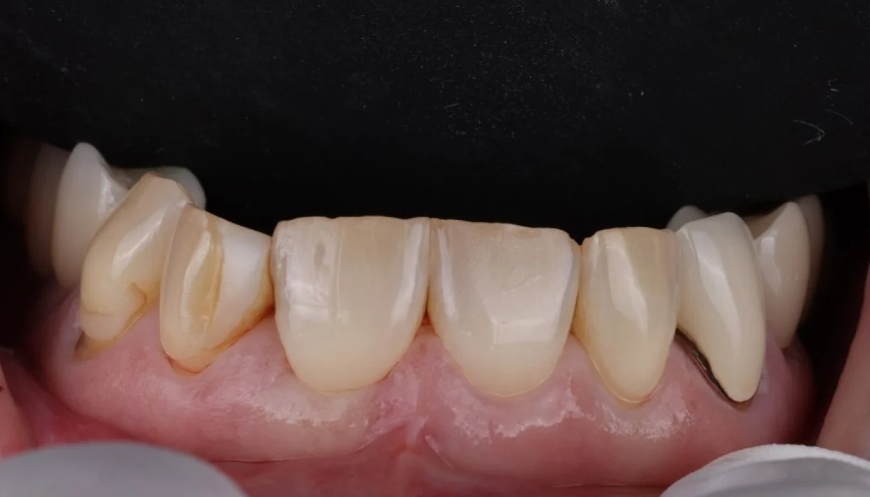 Full mouth reconstruction case 6, before treatment: worn, uneven lower teeth