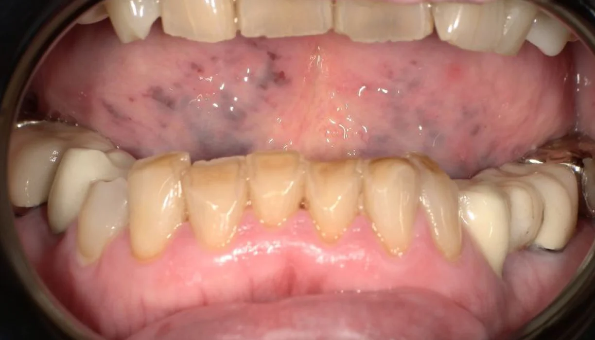 Full mouth reconstruction case 7, before treatment: stained, worn teeth with inflamed gums