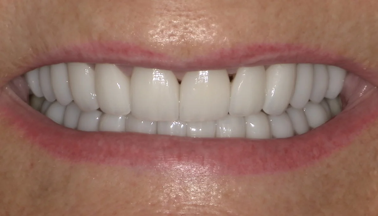 Full mouth reconstruction case 8, after treatment: bright, evenly shaped white teeth