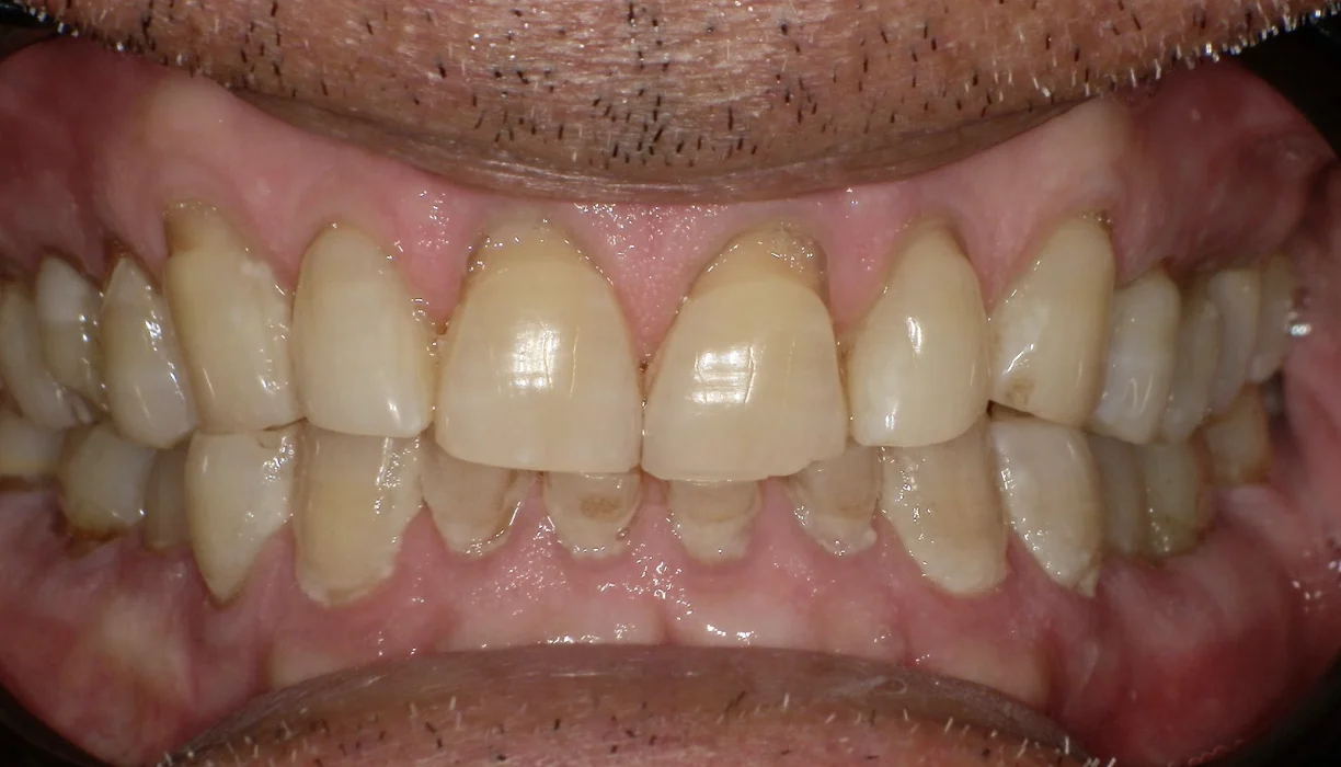 Full mouth reconstruction case 9, before treatment: yellowed, chipped front teeth