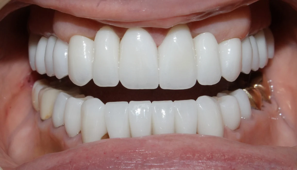 Full mouth reconstruction case 10, after treatment: bright, evenly shaped upper and lower teeth