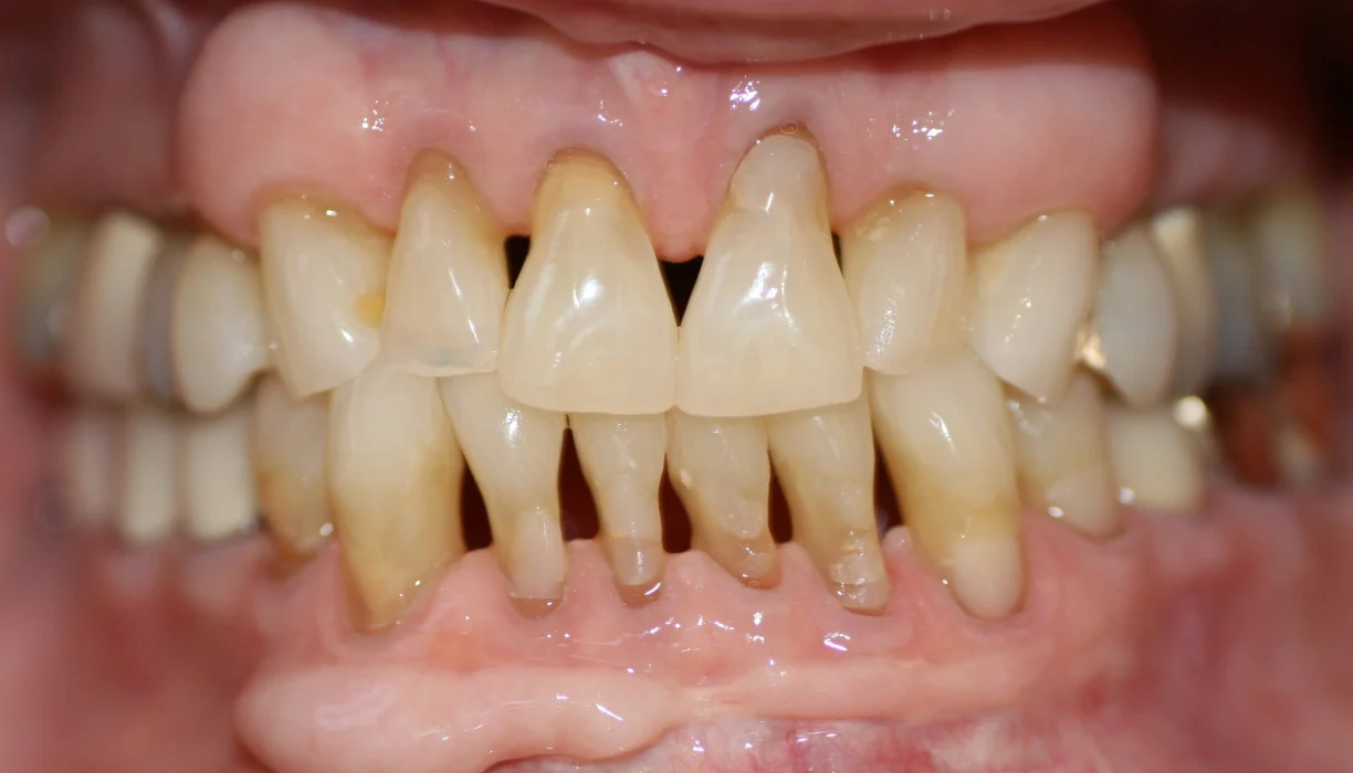 Full mouth reconstruction case 10, before treatment: heavily stained, worn teeth with receding gums
