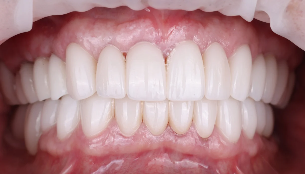 Full mouth reconstruction case 11, after treatment: white, evenly shaped teeth with healthy pink gums