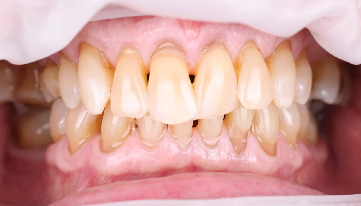 Full mouth reconstruction case 11, before treatment: yellowed teeth with red, swollen gums