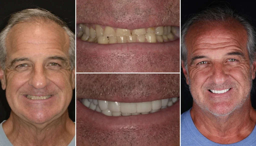Full mouth reconstruction case 12, before and after: older man with gray hair, stained teeth restored to a bright, even smile