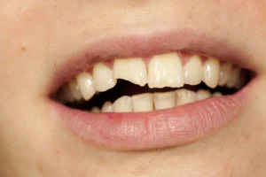 Woman with Beautiful Mouths and Broken Tooth