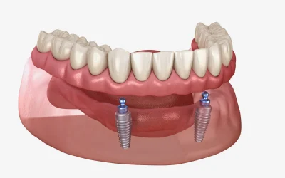 Implant supported dentures in Naples, FL