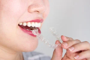 Close up View of a Woman Putting on Invisalign Braces