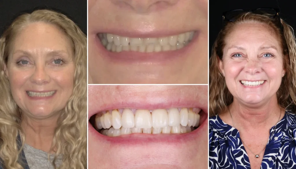 Porcelain veneers case 3, before and after: smiling woman with long blonde hair, teeth changed to a brighter, more even smile