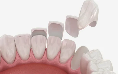 Porcelain Veneers in Naples, FL
