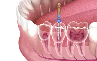 Root Canal Therapy in Naples, FL